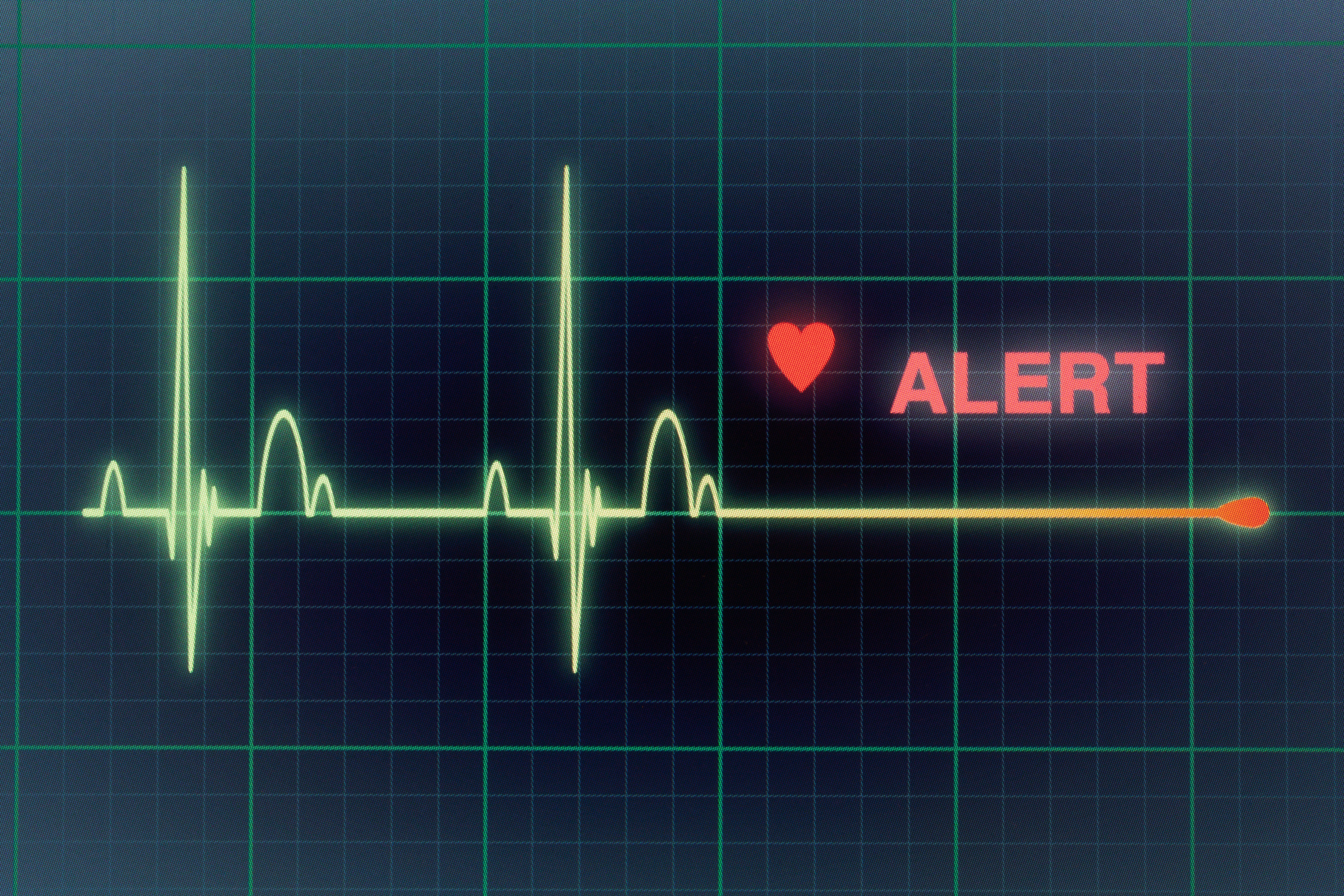 Пульс остановился. Кардиограмма. Остановка сердца на ЭКГ. Остановка сердца на мониторе. Смерть на ЭКГ.